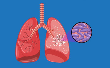 नेपालमा बर्सेनि ६७ हजार क्षयरोगका नयाँ बिरामी थपिँदै, १६ हजारको मृत्यु