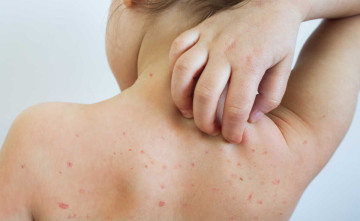 ढोरपाटनमा फैलिएको दादुरा महामारी नियन्त्रणमा