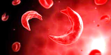 भेरी अस्पतालमा बच्चा जन्मेको २४ घण्टामा सिकलसेल परीक्षण गर्न सकिने