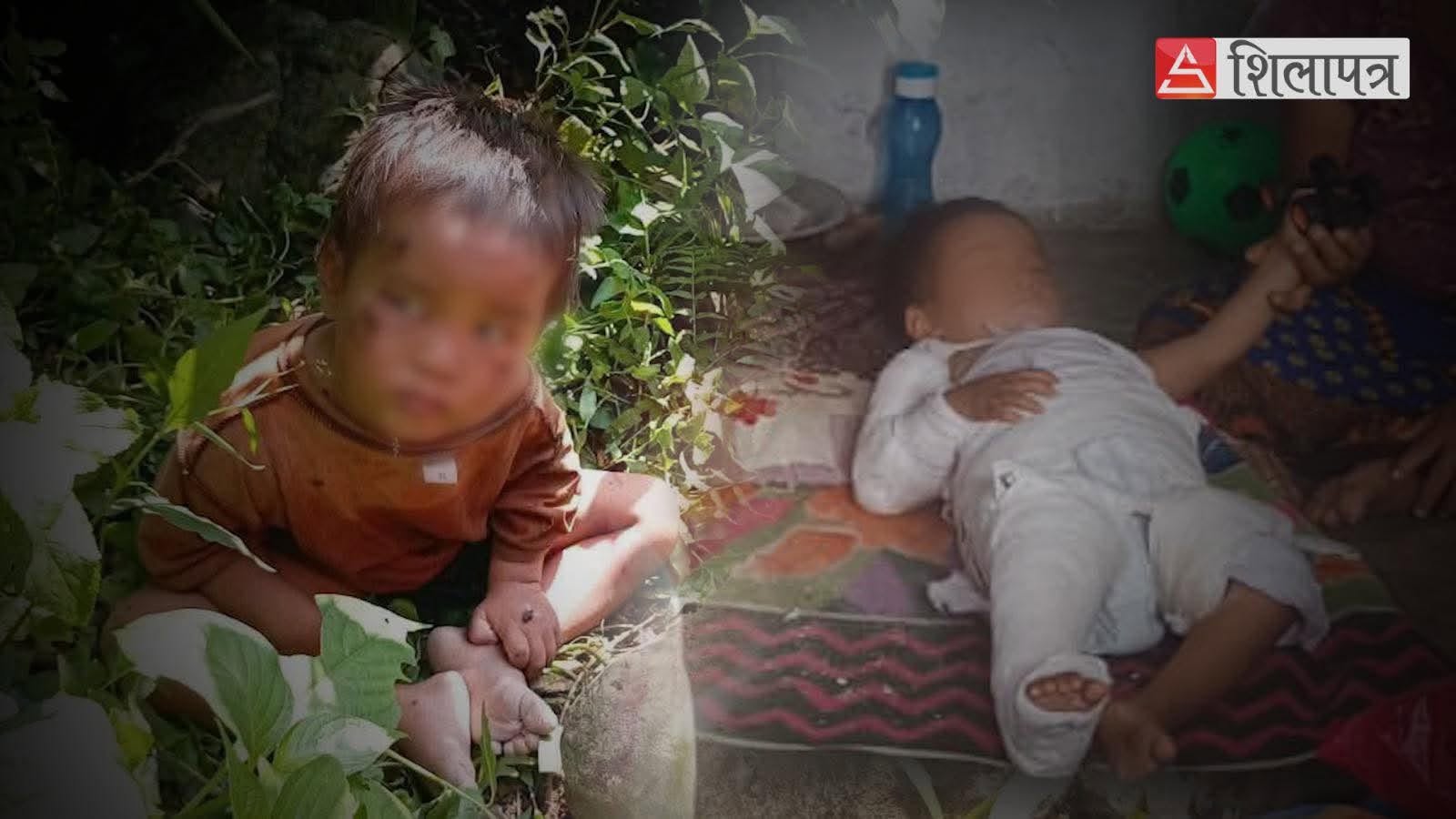 तीन दिनपछि जंगलबाट उद्धार गरिएका बालकको हप्ता दिनपछि हातखुट्टामा प्लास्टर [भिडियाे]