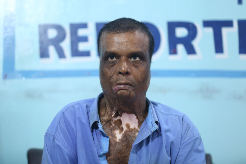 आलम प्रकरणका घाइते काठमाडौंमा : 'अब कसरी बाँचाैँ' भन्दै सुनाए १७ वर्षअघिको रामकहानी