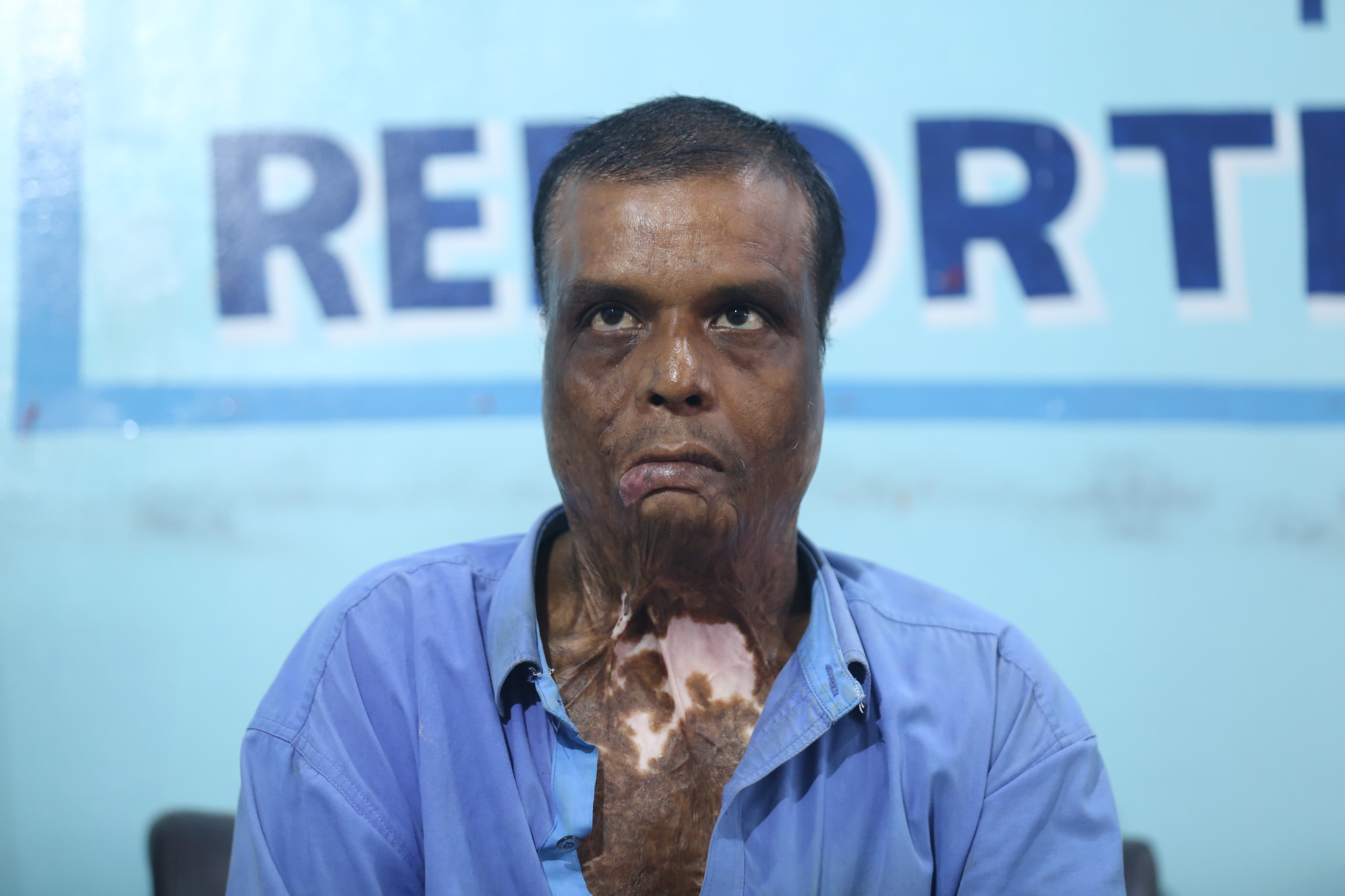 आलम प्रकरणका घाइते काठमाडौंमा : 'अब कसरी बाँचाैँ' भन्दै सुनाए १७ वर्षअघिको रामकहानी